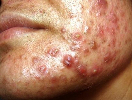 Simptome conglobulare de acnee și tratamentul formei severe de acnee