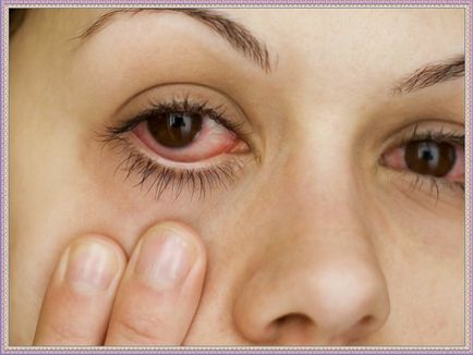 Кон'юнктивіт очей лікування у дітей - особливості протікання хвороби