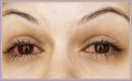 Кон'юнктивіт очей лікування у дітей - особливості протікання хвороби