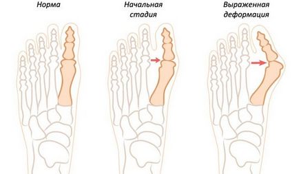 Кісточки на ногах - причини виникнення і методи лікування
