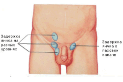 Cryptorchidism sau tratament conservator