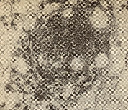 Sângerări (înțeles) - tulburări de circulație sanguină și circulație limfatică - anatomie patologică - miere