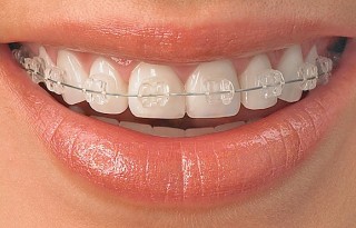 Kedvezményes kuponok Braces