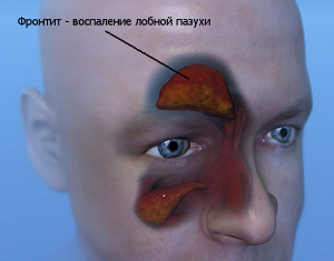 Лікування фронтита, як і чим краще проводити терапію