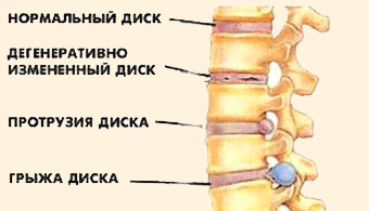 Tratamentul herniilor spinale fără intervenție chirurgicală, metode alternative