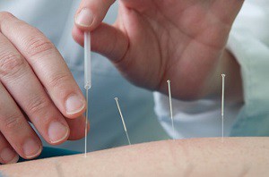 Tratamentul acupuncturii pentru prinderea nervului sciatic