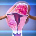 Tratamentul miomului uterin este metodele medicamentelor, conservatoare