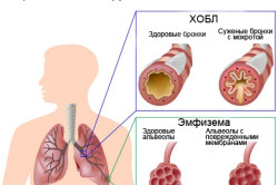 Medicamente de la bronșita fumătorului