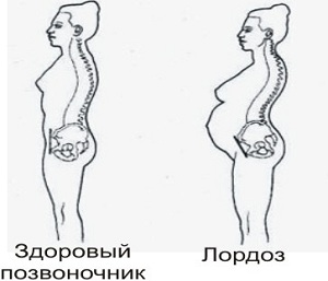 Лордоз як в домашніх умовах визначити паталогію спинного прогину