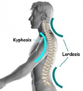 Lordoza coloanei vertebrale cervicale, simptome, cauze și tratament