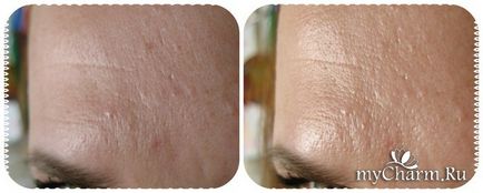 Completarea mascului - întinerire cu acid hialuronic și celule stem (regenerare profundă instantanee) Completarea mascului - întinerire cu acid hialuronic și celule stem
