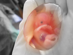 Avortul medical - terminarea artificială a sarcinii, complicațiile, consecințele,