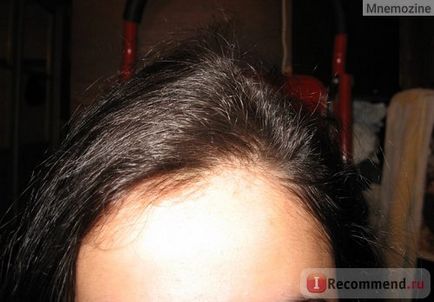 Mezoterápia haj és a fejbőr - „veszteség megállt érezhető növekedése - frissítés” vásárlói vélemények