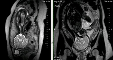 Мрт експерт, антенатальної дослідження плоду (МРТ плода)