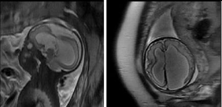 Мрт експерт, антенатальної дослідження плоду (МРТ плода)