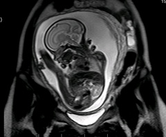 Мрт експерт, антенатальної дослідження плоду (МРТ плода)