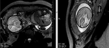 Мрт експерт, антенатальної дослідження плоду (МРТ плода)