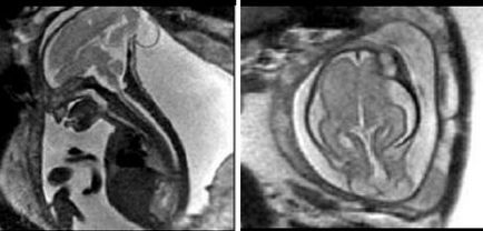 Мрт експерт, антенатальної дослідження плоду (МРТ плода)