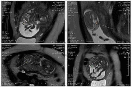 MRI a magzat a terhesség alatt Kazan