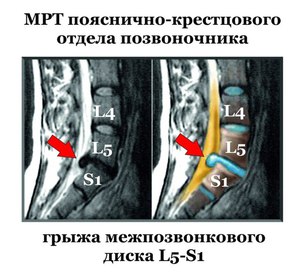MRI az ágyéki keresztcsonti gerinc készítmény és eljárás lefolytatása