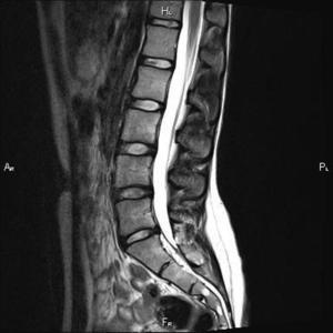 MRI az ágyéki keresztcsonti gerinc készítmény és eljárás lefolytatása