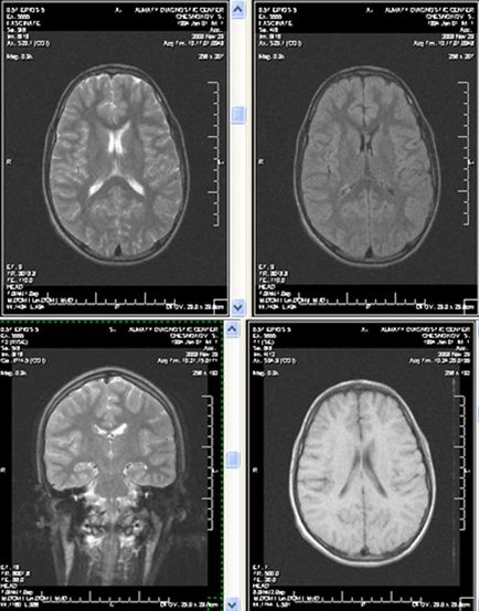 Mortografia canalului creierului, avicena