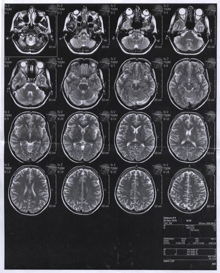 Mortografia canalului creierului, avicena