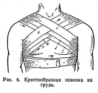 накладення пов'язок