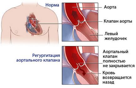 Inadecvarea valvei cardiace aortice 1, 2, 3 grade, tratament, cauze, simptome, modul în care este tratată