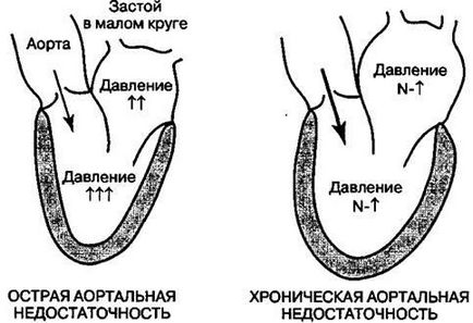 Недостатність аортального клапана серця 1, 2, 3 ступеня, лікування, причини, симптоми, як лікується