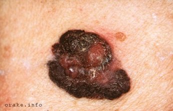 Nevus mehet a fényképet rákok (bőr) Nevus is alakulnak rák fotó