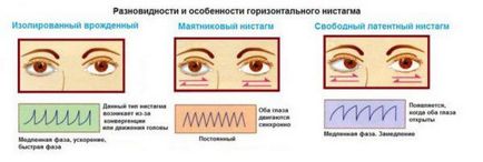 Nistagmusul globului ocular care este, provoacă apariția unor afecțiuni spontane, congenitale, rotative,