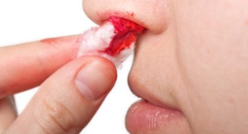Носові кровотечі у дорослих причини і лікування
