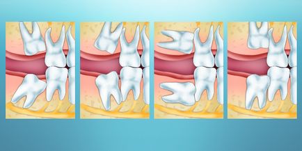 Trebuie să elimin dinții de înțelepciune?