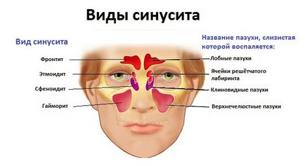 Tratamentul sinuzită maxilară odontogenă, cauze