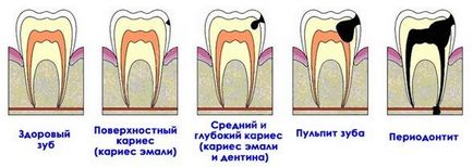 Pericolul în timp nu este vindecarea parodontitei, ce este parodontita, forme și tipuri