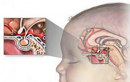 Пухлини головного мозку у дітей симптоми і ознаки