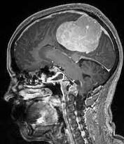 Пухлини мозку - менінгіома
