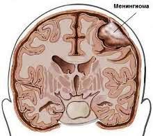 Agydaganatok - meningeoma