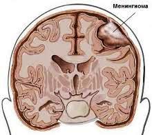 Tumori ale creierului - meningiom