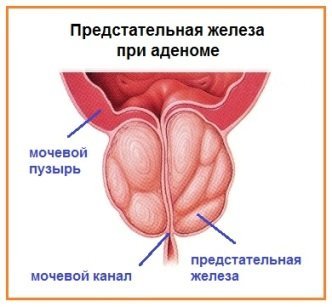 Ускладнення після видалення аденоми передміхурової залози