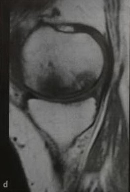 Osteonecroza articulației genunchiului, osteonecroză spontană aseptică a articulației genunchiului