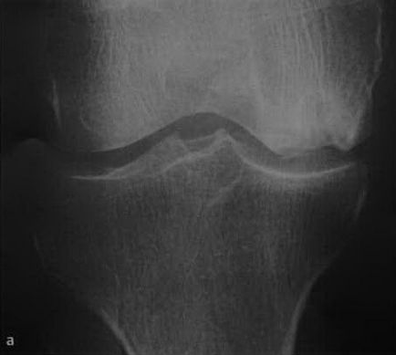 Osteonecroza articulației genunchiului, osteonecroză spontană aseptică a articulației genunchiului