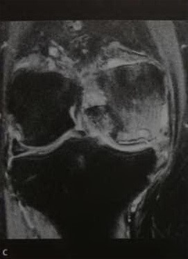 Остеонекроз колінного суглоба спонтанний асептичний остеонекроз колінного суглоба