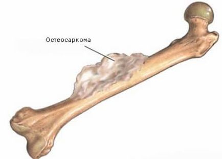 Osteosarcoma a combcsont okoz, tünetek és a kezelés