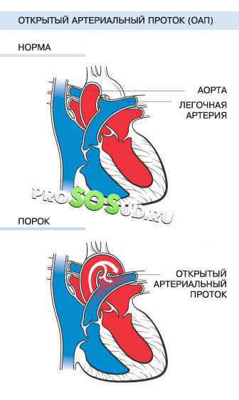 Nyitott ductus arteriosus újszülöttek kezelt, tünetei, diagnózisa