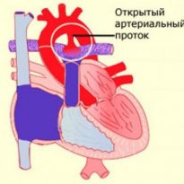 Відкрита артеріальна протока у новонароджених дітей лікування, симптоми, діагностика