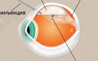 Відшарування сітківки ока симптоми, що це таке, операція, лікування, народними засобами