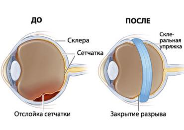 Detașarea retinei simptomelor ochiului, ce este, operația, tratamentul, remedii folclorice