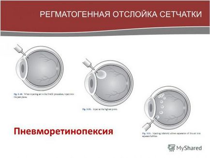 Detașarea retinei simptomelor ochiului, ce este, operația, tratamentul, remedii folclorice